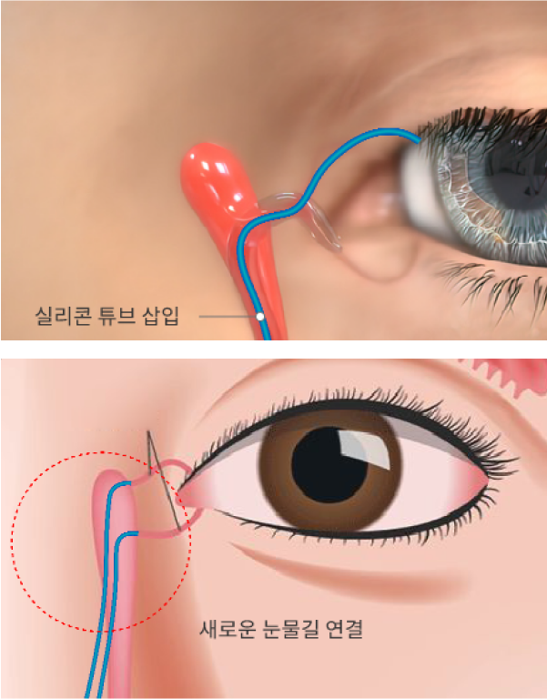 눈물흘림 질환_mo